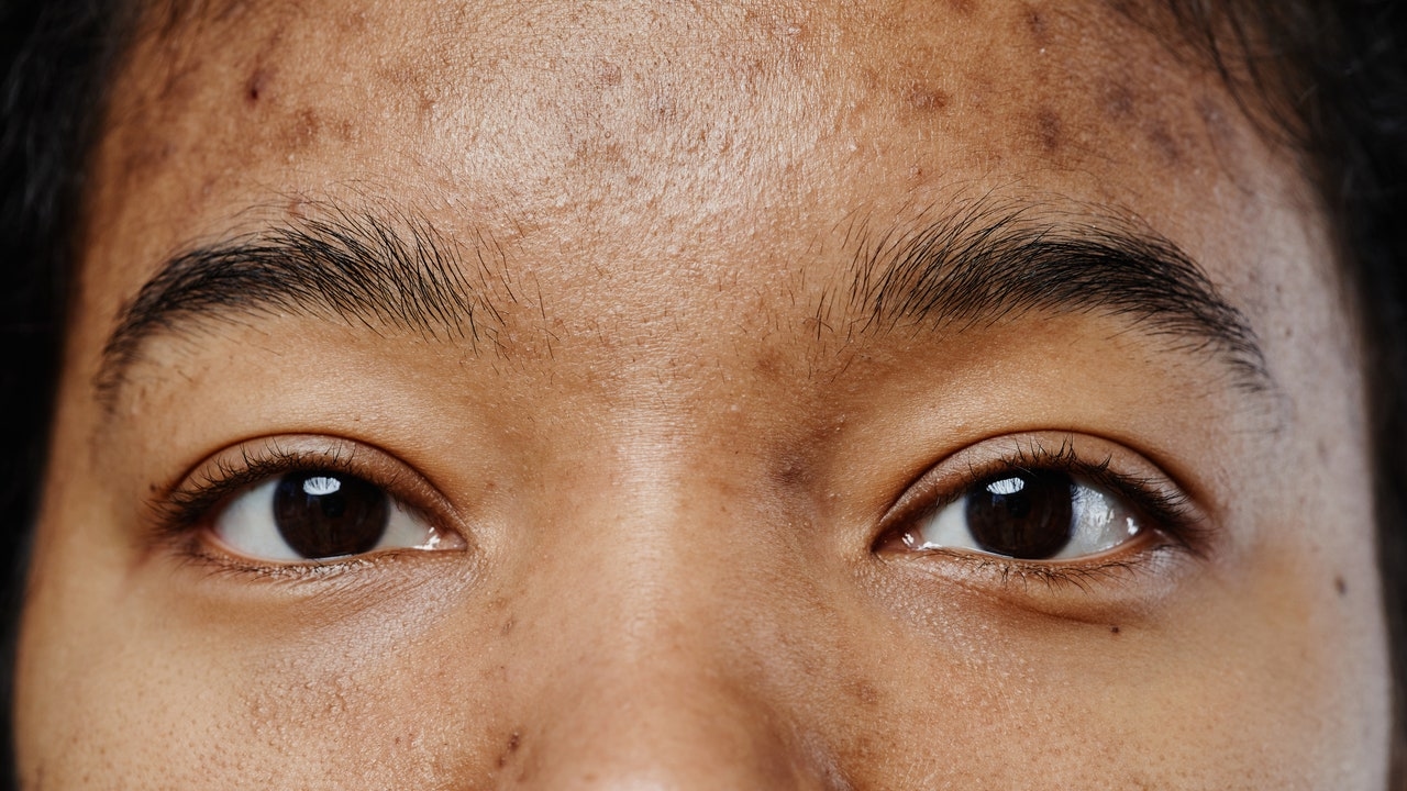 La « seconde puberté » pourrait être à l'origine de votre acné adulte, expliquent les dermatologues.