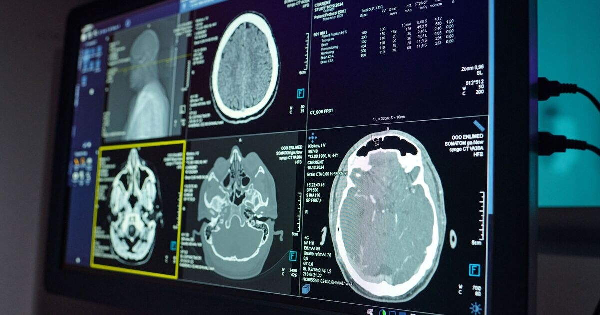 Uno studio sull'Alzheimer fa una scoperta sorprendente rispetto alle persone più socievoli