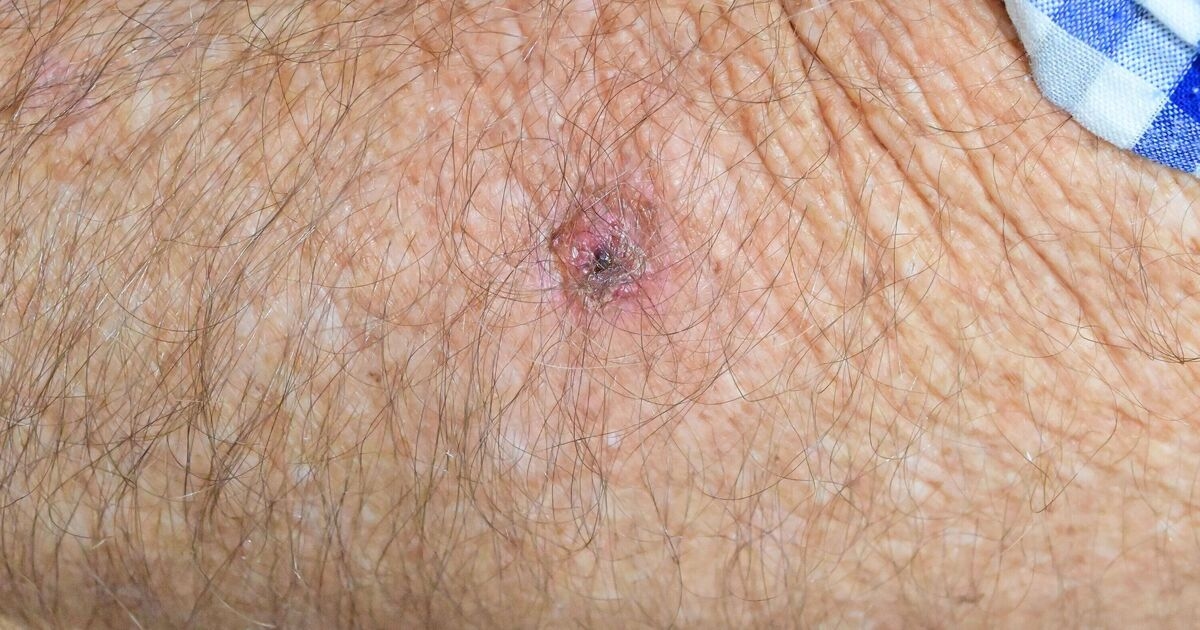 GP shares one red flag that means a spot could be skin cancer