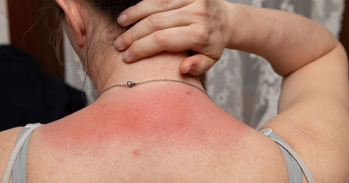 Weird 1p period pad tip that can soothe sunburn pain