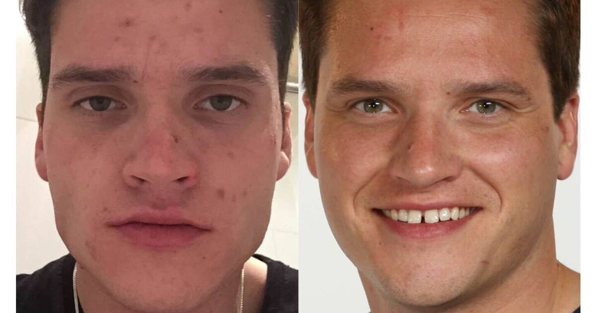 „Meine Oma hat meine Akne in vier Tagen mit einer Überraschungscreme geheilt.“