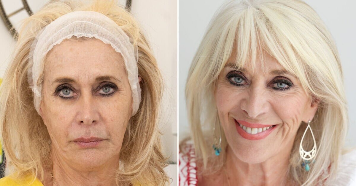 Después de una rápida pérdida de peso, ¿podría un cóctel de esperma de salmón rejuvenecer mi “cara Ozempic”?