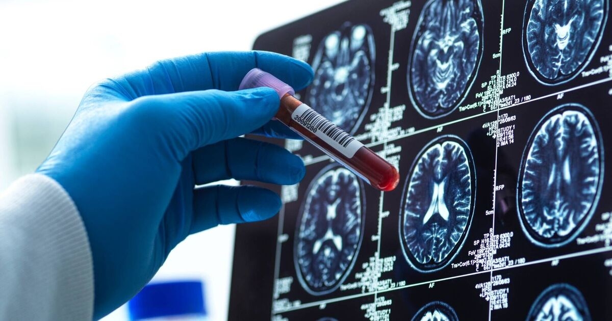 Breakthrough blood test diagnoses Alzheimer's early with 95% accuracy