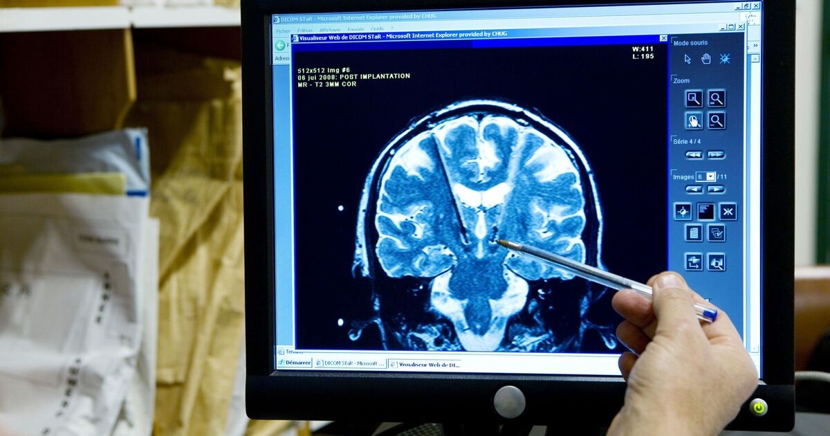 Psychopaths have a VERY different brain size to the rest - and it's not what you think