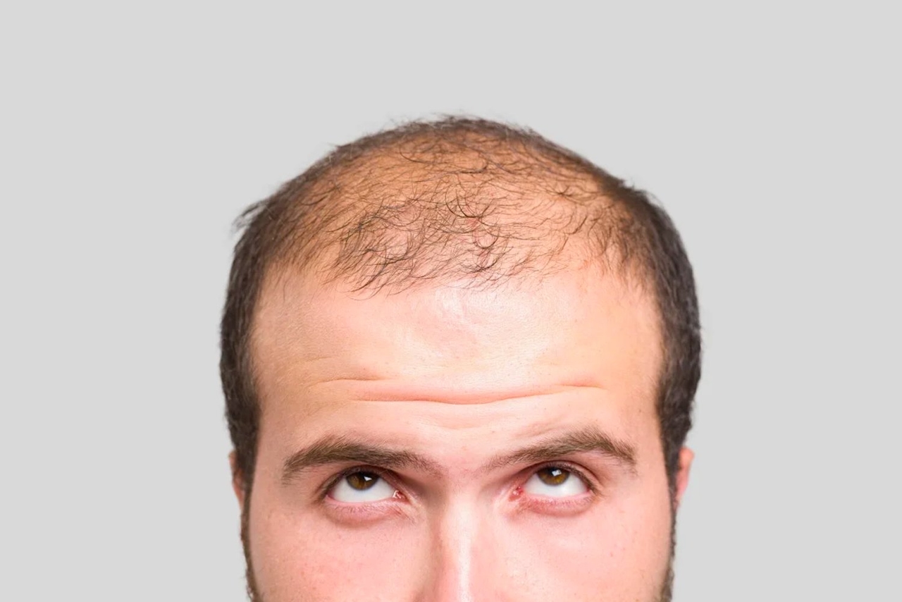 UCLA Scientists Develop Topical Cream That Regrows Hair in Just One Week
