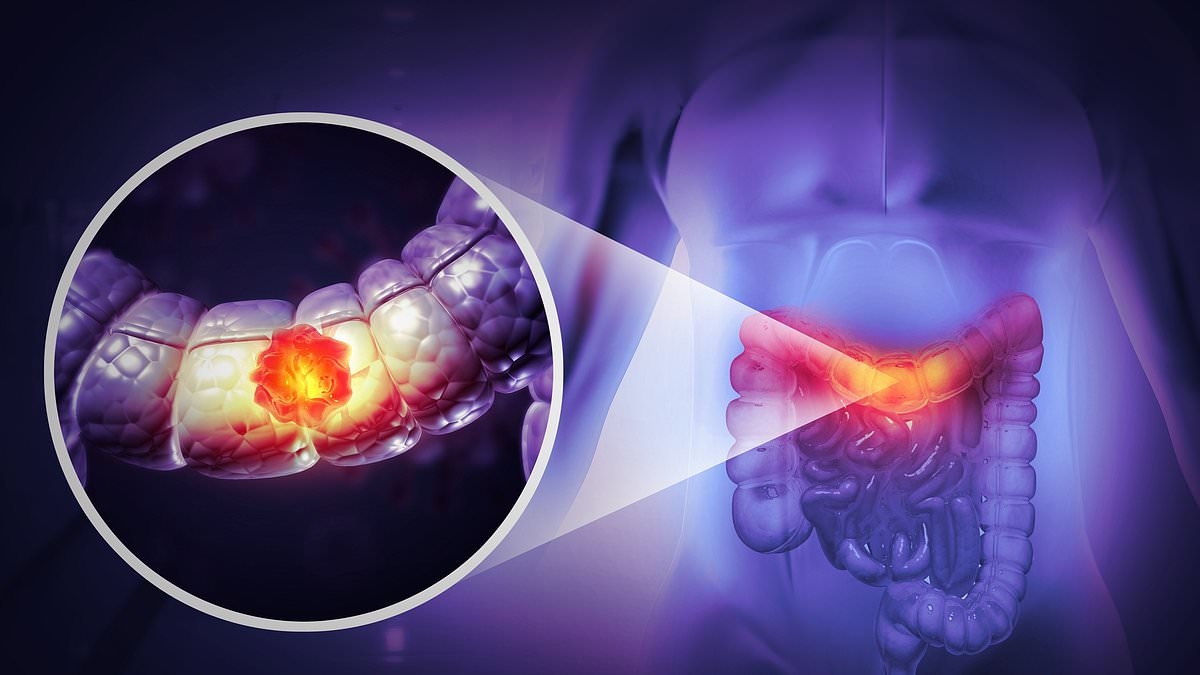 Expert reveals five 'pain free' symptoms of bowel cancer - as cases surge in young people