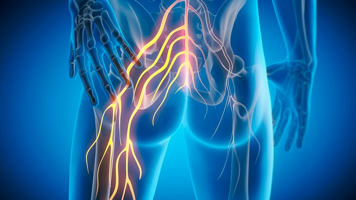 How to cure your sciatica for good - WITHOUT powerful drugs: Our experts reveal the simple steps and lifestyle tweaks to save yourself from the debilitating condition