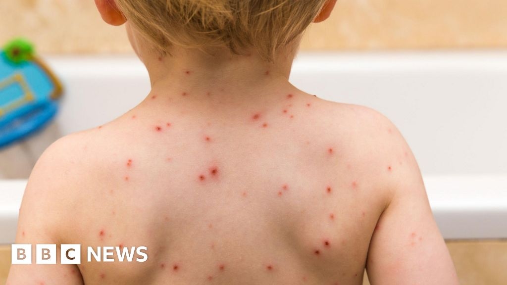 Kinderen krijgen waterpokkenvaccin aangeboden via NHS