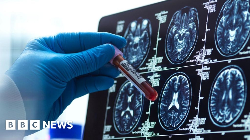Exame de sangue para Alzheimer pode 'revolucionar' o diagnóstico