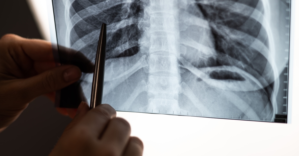Le cancer du poumon se classe au 6e rang des maladies mortelles