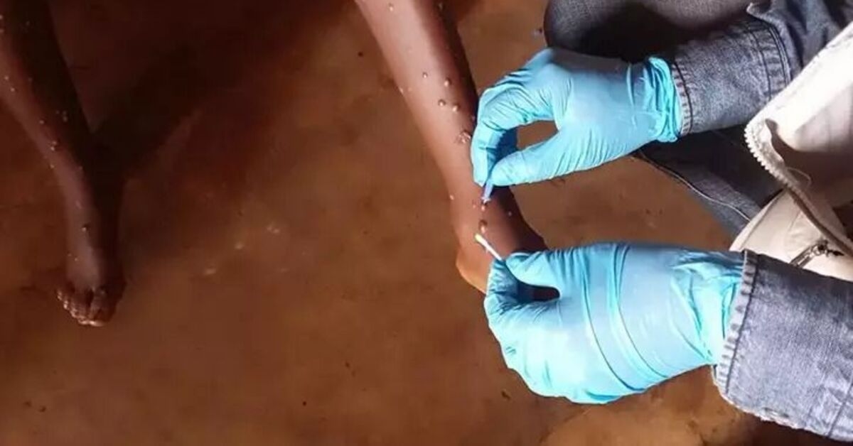 M-Pocken-Fälle in Ghana steigen auf 302