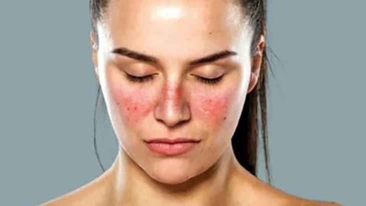 Des taches sur le visage peuvent être un signe de lupus ! Ce trouble peut toucher de nombreux organes.