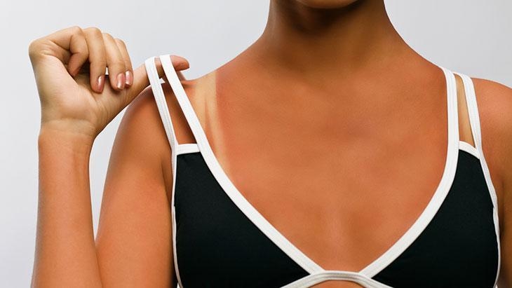 ¡Tener la piel bronceada está de moda este verano! «No existe un bronceado saludable».