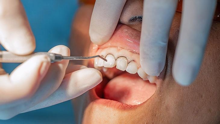 Le danger caché dans la bouche : la récession gingivale ! La principale cause est le tartre.