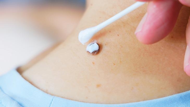 Sommige mensen laten hun moedervlekken verwijderen met lasers, anderen met oplossingen! 'Niet elke moedervlek is onschuldig, die moet onderzocht worden'
