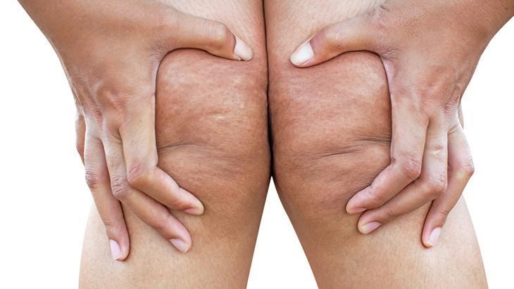 Lipedeem is de stille schreeuw van vrouwen! Het antwoord voor degenen die vragen: "Waarom kan ik niet afvallen?"