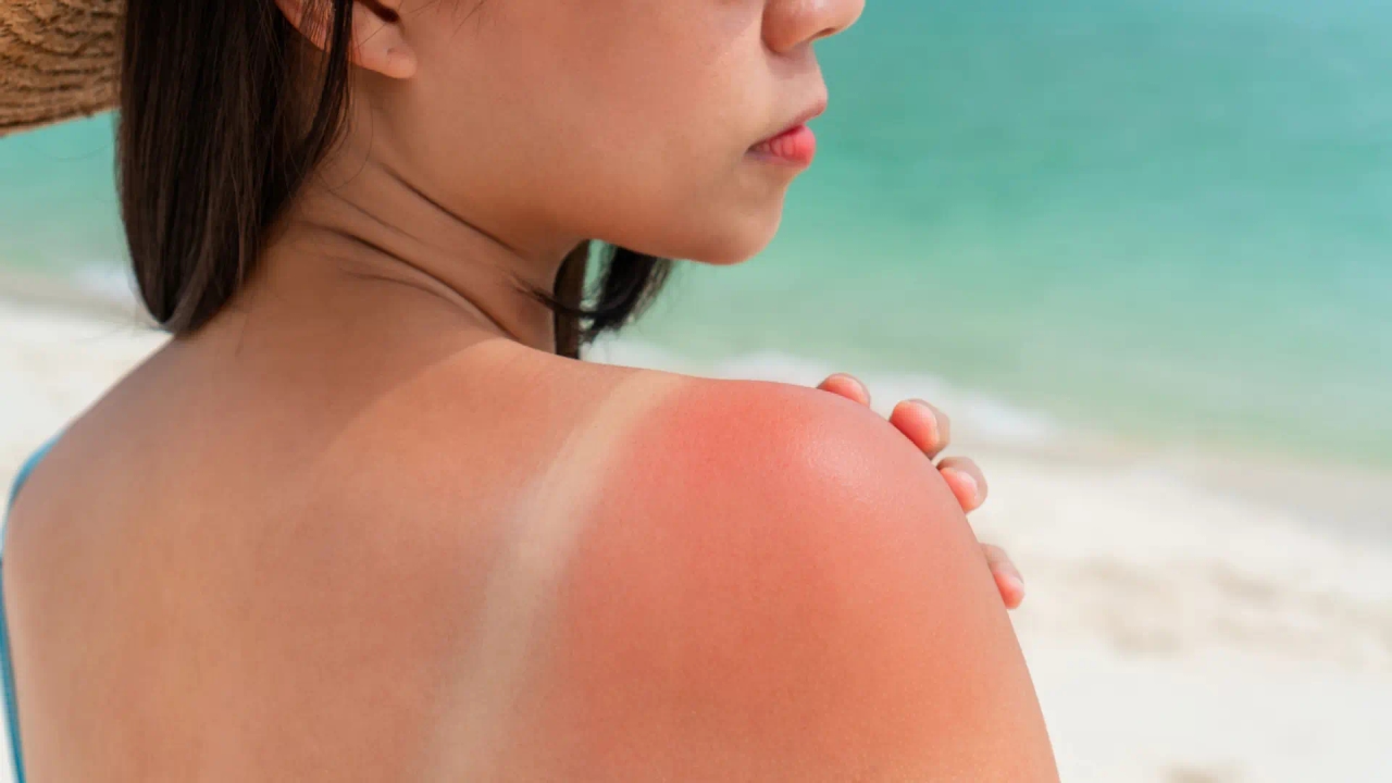 Fünf Möglichkeiten, Sonnenbrand schneller zu heilen, laut einem Dermatologen