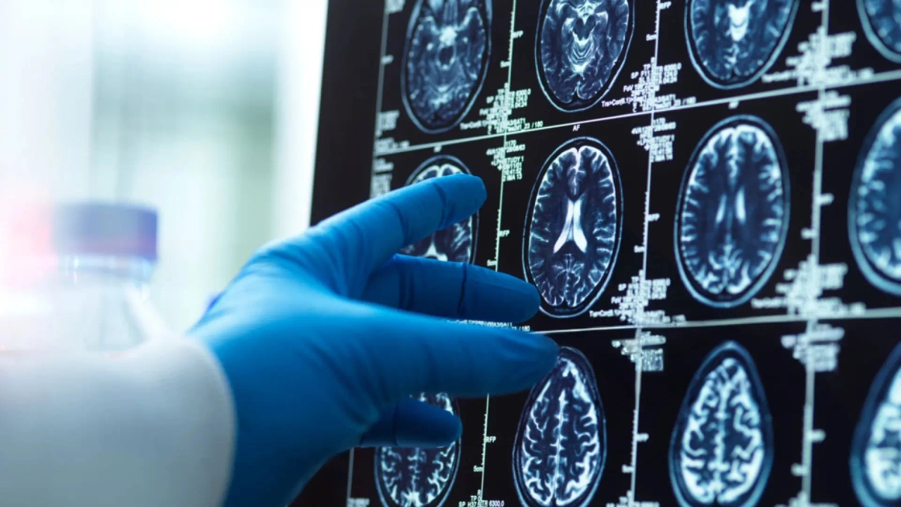 Hiszpańscy naukowcy przewodzą w tworzeniu pierwszego transdiagnostycznego atlasu mózgu dla zaburzeń psychicznych.