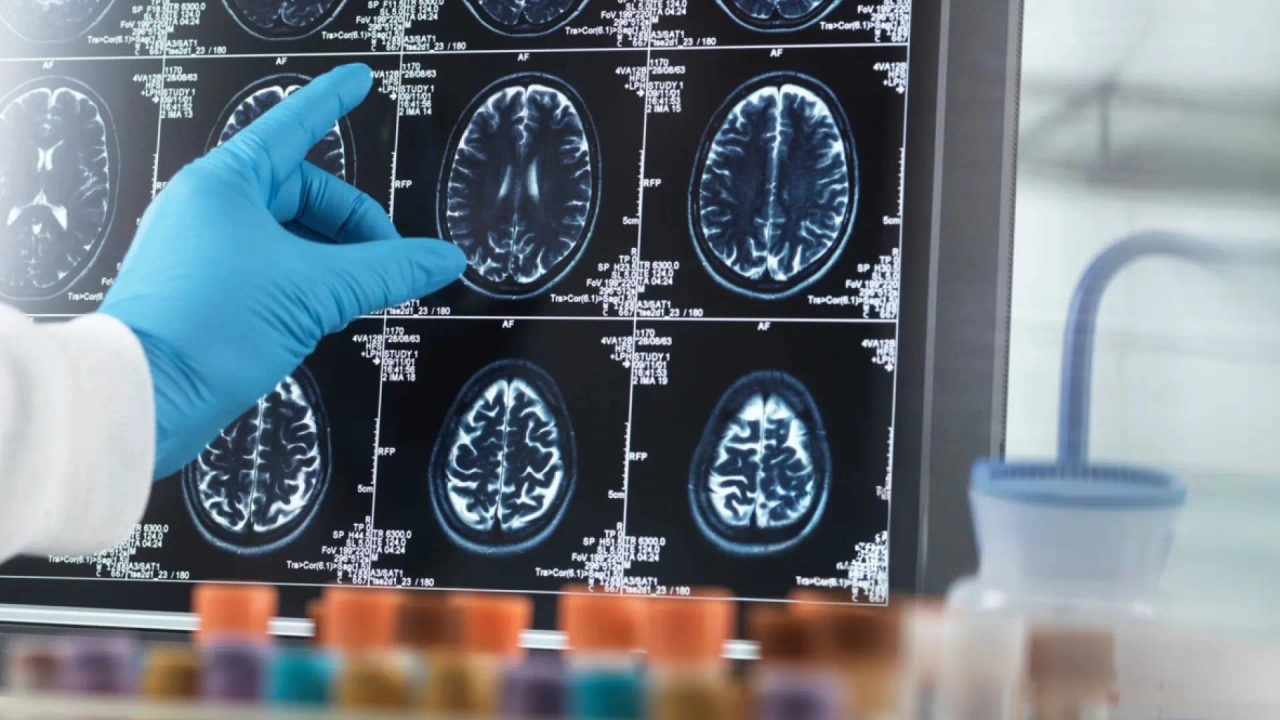 Um novo tratamento com implante cerebral está revolucionando o tratamento do Parkinson.