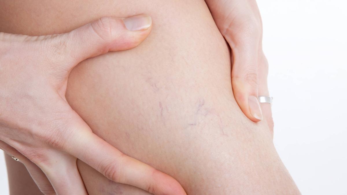 Varizes: Um em cada quatro adultos pode desenvolver essa condição. Como podemos preveni-la?