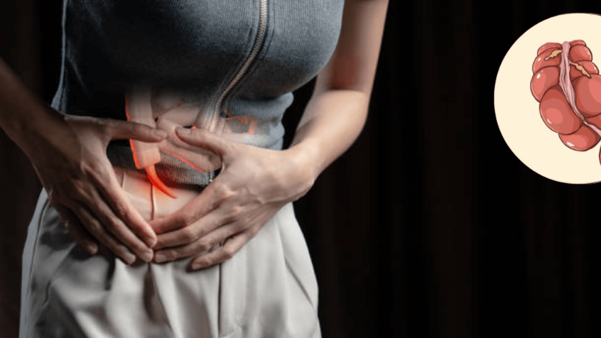 Appendix cancer is on the rise among young people: What symptoms should you watch out for?