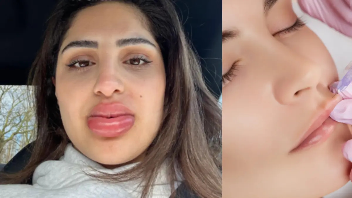 Una giovane donna si è sottoposta a un trattamento estetico e le è stato ritrovato l'aspetto di una bambola Bratz.