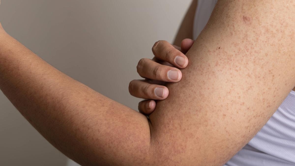 So werden Sie Hühnerhaut an Ihren Armen los: der ultimative Trick laut Experten der Mayo Clinic.
