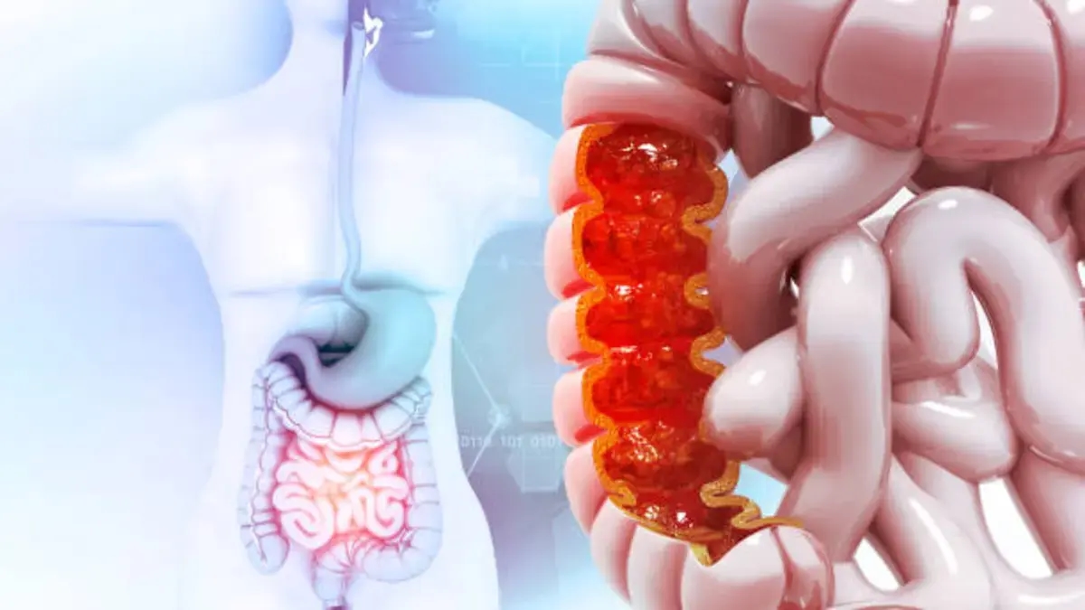 Cáncer de colon: el síntoma inicial que puede pasar desapercibido y es clave para la detección temprana