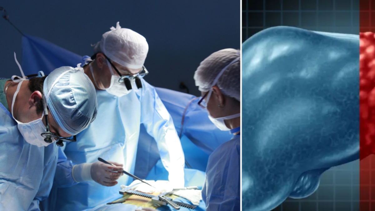 Doktorlar, genetiği değiştirilmiş domuz karaciğeriyle 171 gün hayatta kalan bir hastanın durumunu analiz ediyor: 'Önemli bir gelişme'