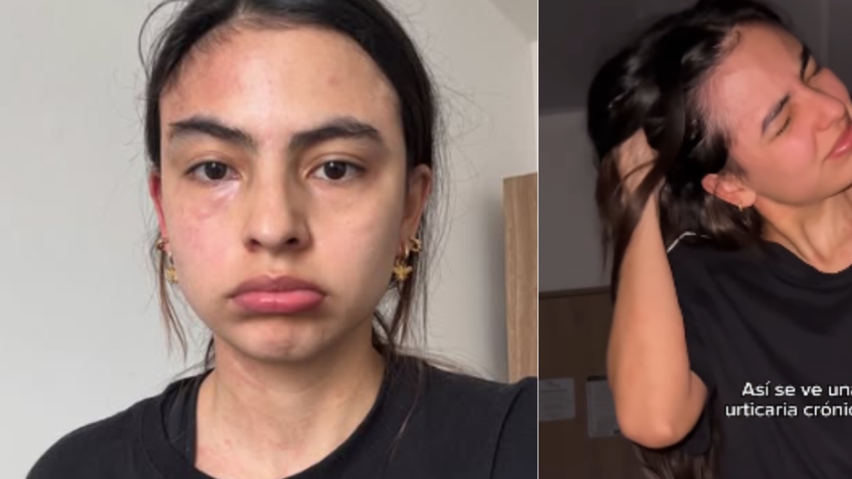 Michell Orozco, attrice di "Lady of the Roses", non riesce a dormire da tre mesi a causa di un attacco cronico di orticaria: "È stato orribile"