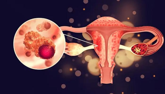 Achten Sie auf diese Symptome von Eierstockkrebs! Die dritthäufigste Krebsart bei Frauen ...