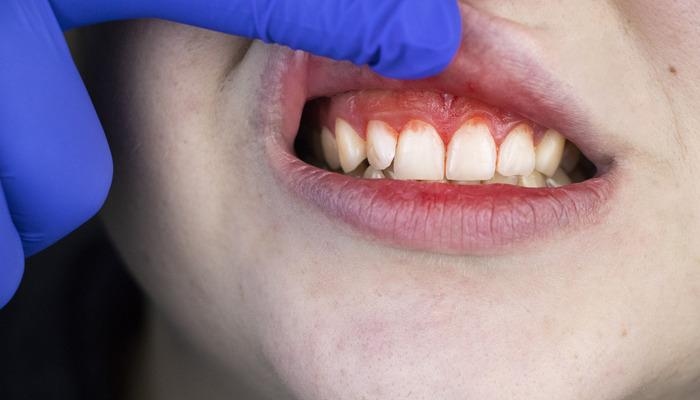 Nie lekceważ tego, bo to proste: Ten objaw w jamie ustnej może być pierwszym sygnałem białaczki! To zaczyna się nagle