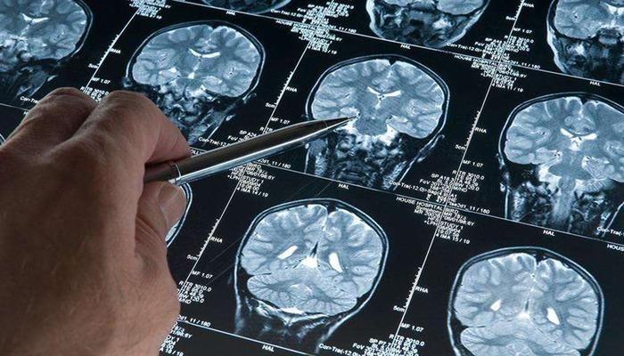 Ukryte niebezpieczeństwo u mężczyzn! W badaniach nad chorobą Alzheimera odkryto wariant genetyczny, który zwiększa ryzyko demencji: Ryzyko rozwoju u mężczyzn z tym wariantem wynosi 2,39