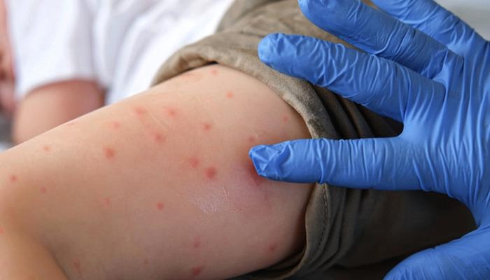 Yeni küresel salgın uyarısı: Chikungunya virüsü Türkiye'de var mı? Uzman isim açıkladı: "Aedes türüne ait sivrisinek İstanbul'da görüldü"