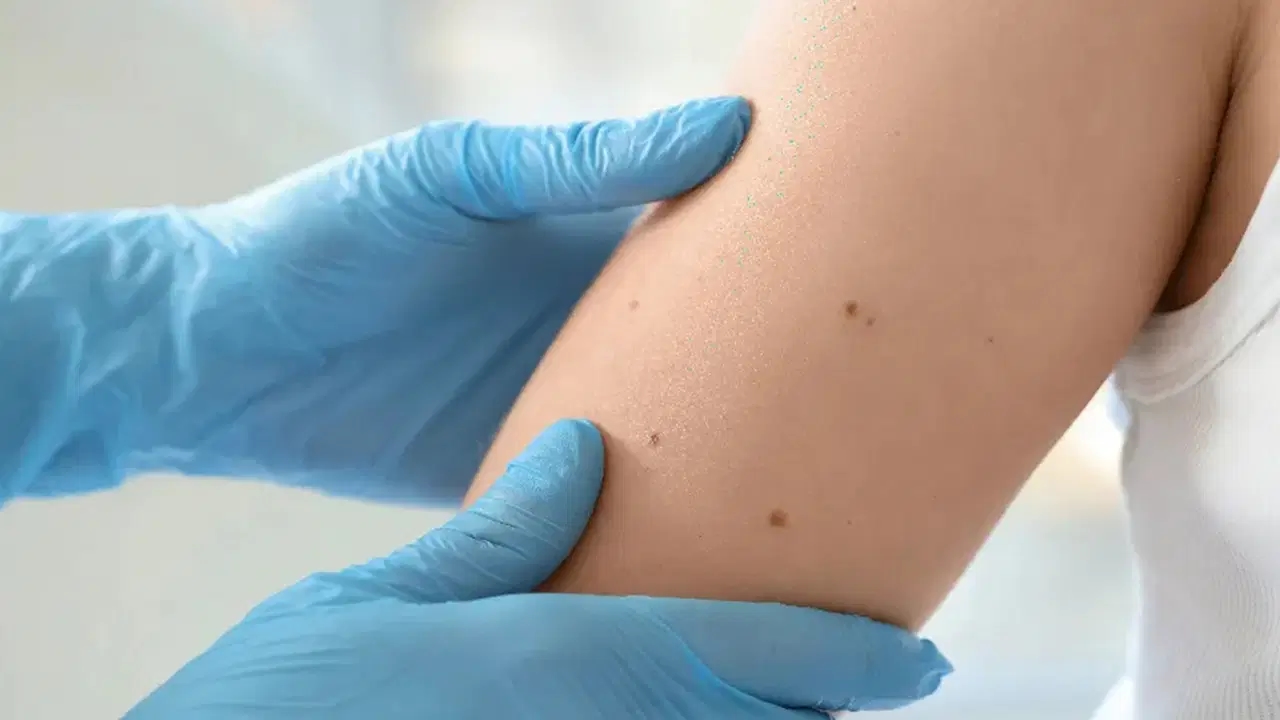 'Prendi le precauzioni necessarie contro il sole per proteggerti dal cancro della pelle'