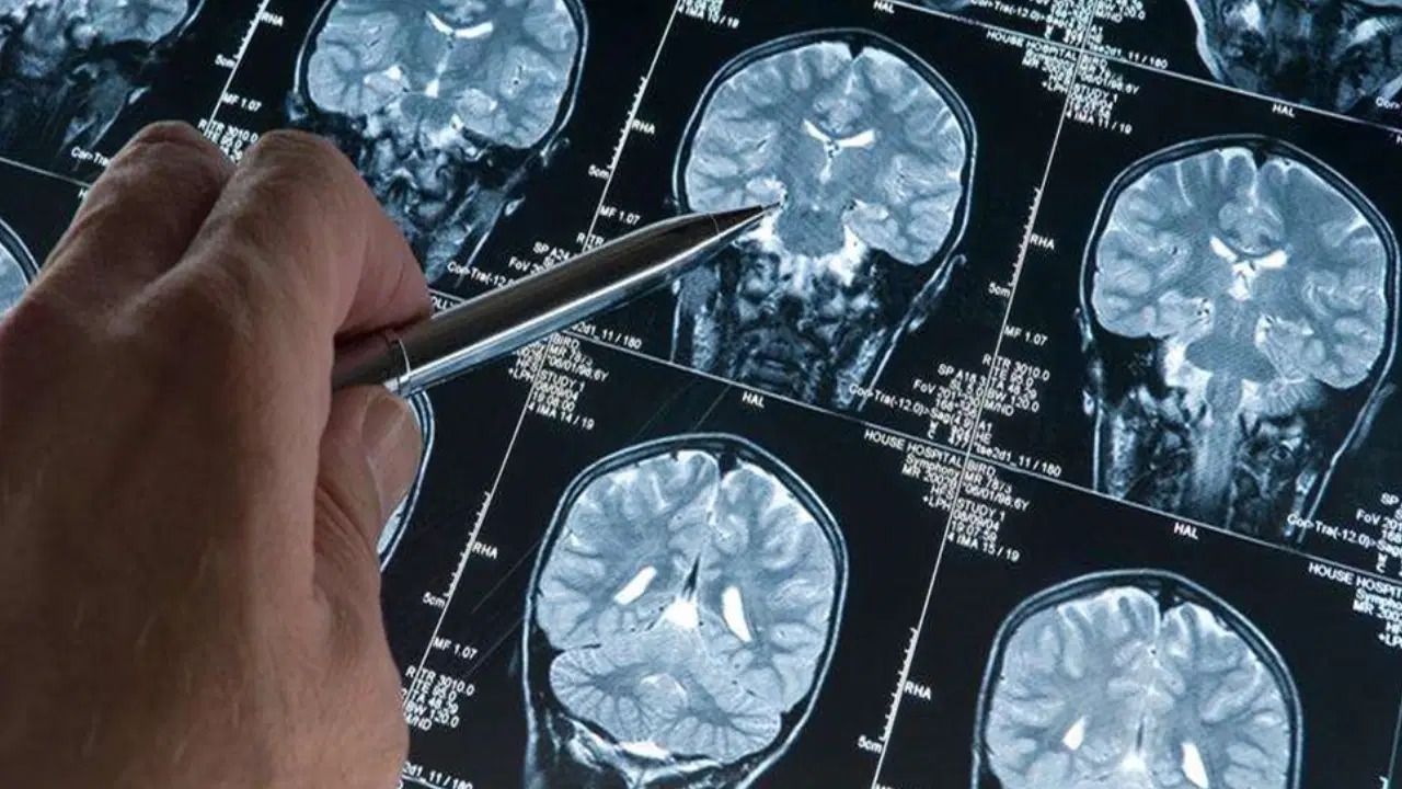 Um novo passo no diagnóstico precoce: a era do "exame de sangue" no Alzheimer