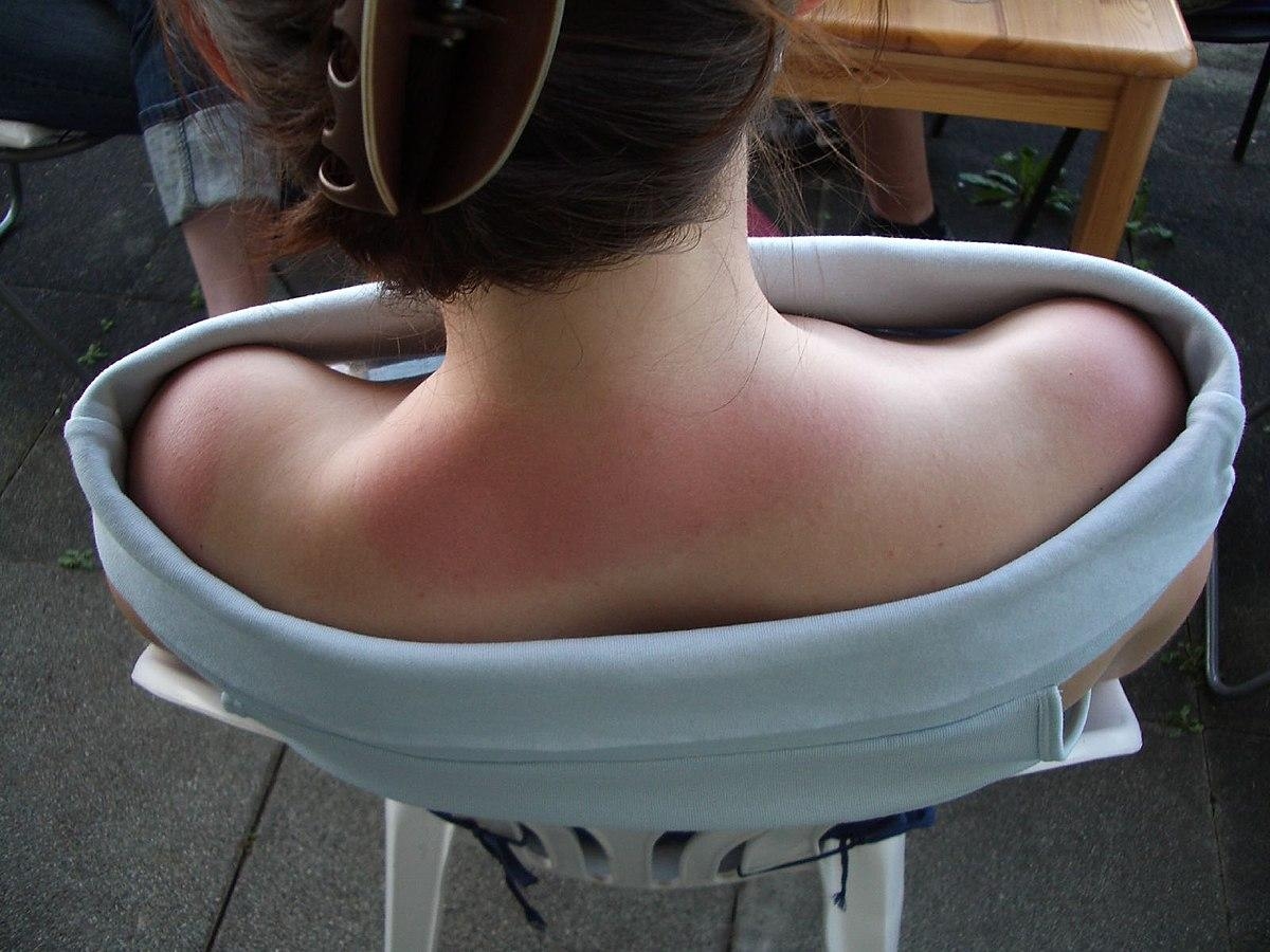 Sonnenexposition: „Sonnentattoo“, „Brandstreifen“ oder „Bräunungsstreifen“… Der Gesundheitsminister warnt vor diesen gefährlichen Trends