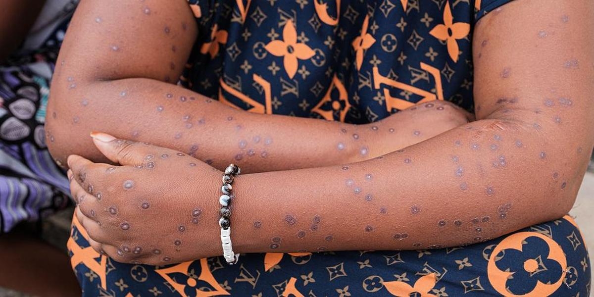 A case of MPOX detected in Senegal, Dakar takes measures to fight the disease
