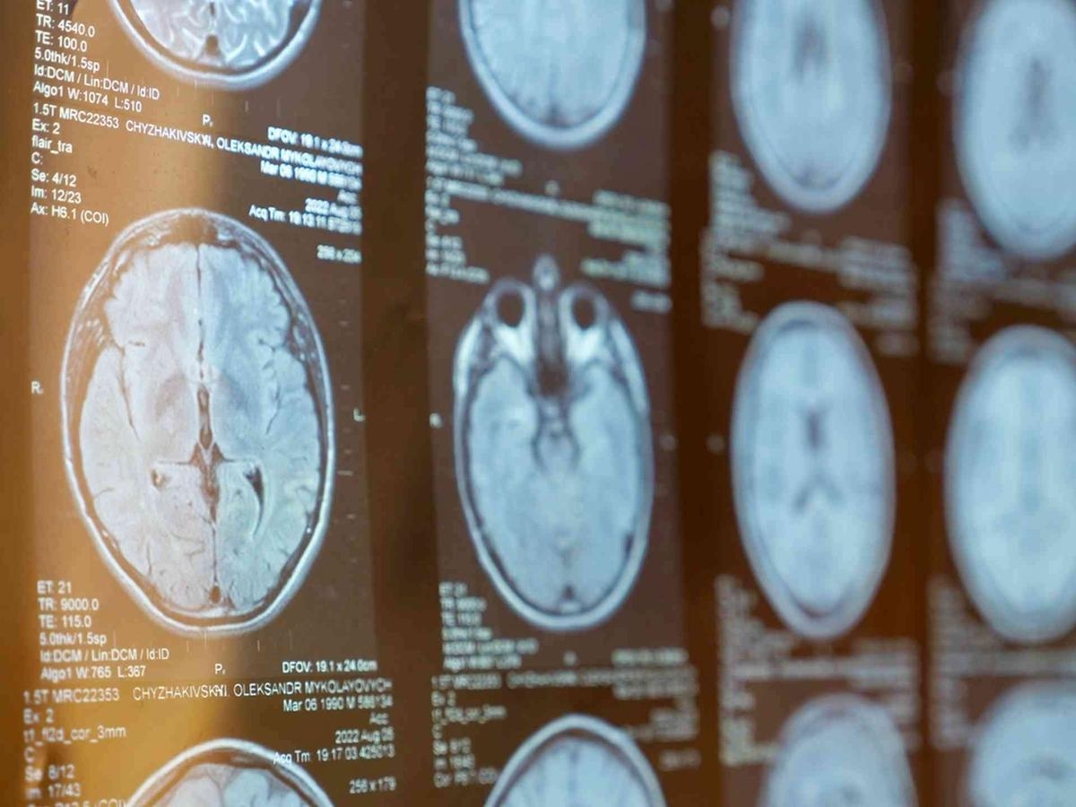 Esclerosis Múltiple: ¿Por qué nuestro sistema inmunológico se vuelve contra nosotros?