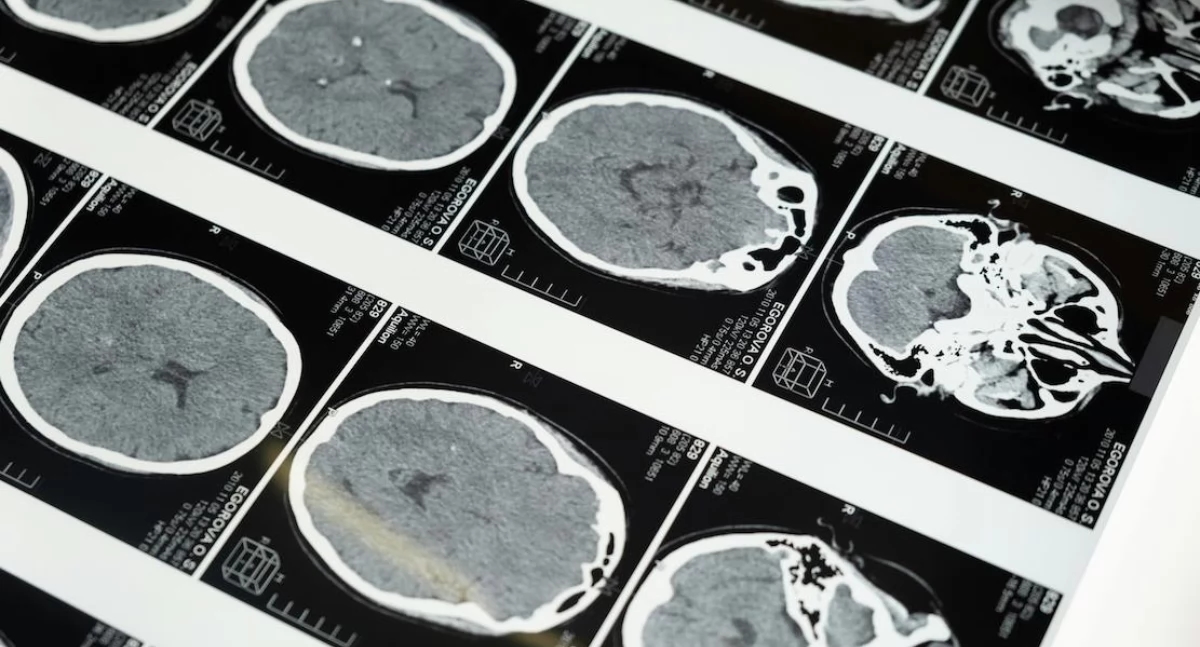 Novo método para testar olfato e visão oferece esperança para diagnóstico precoce da doença de Parkinson