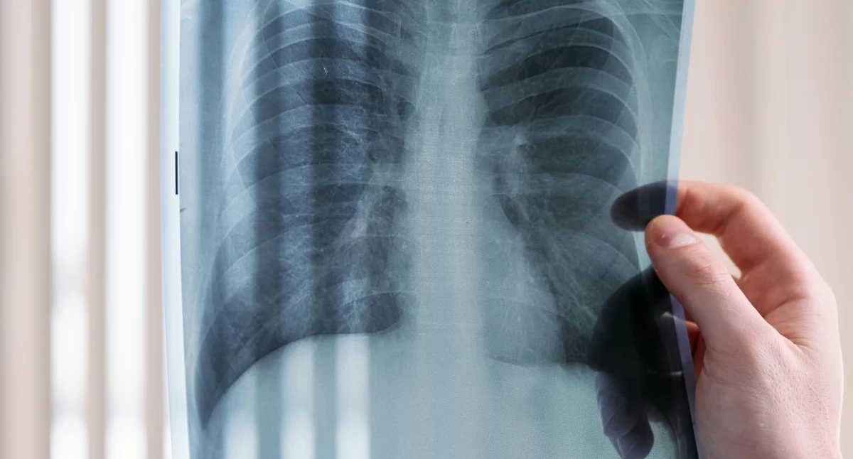 Rak płuca staje się w Polsce niemal epidemią. Eksperci: "Diagnostyka trwa tak długo, że pacjent przestaje być kandydatem do leczenia"