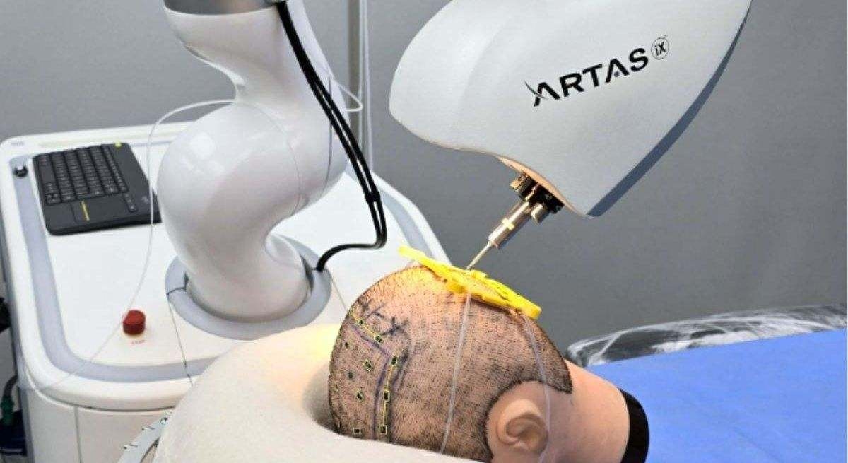 L'intelligenza artificiale promette di curare l'alopecia: ecco ARTAS iX, il robot che ti restituisce i capelli.