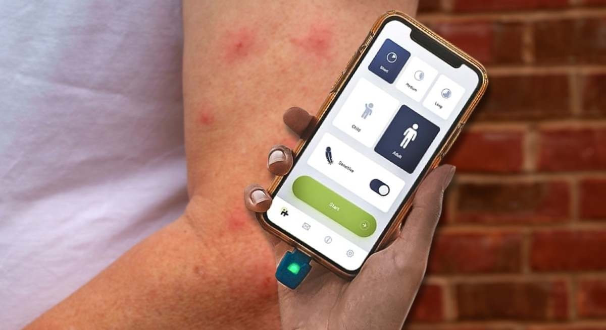 Zeg vaarwel tegen het krabben aan muggenbeten: de uitvinding die een einde maakt aan de jeuk van je mobiele telefoon
