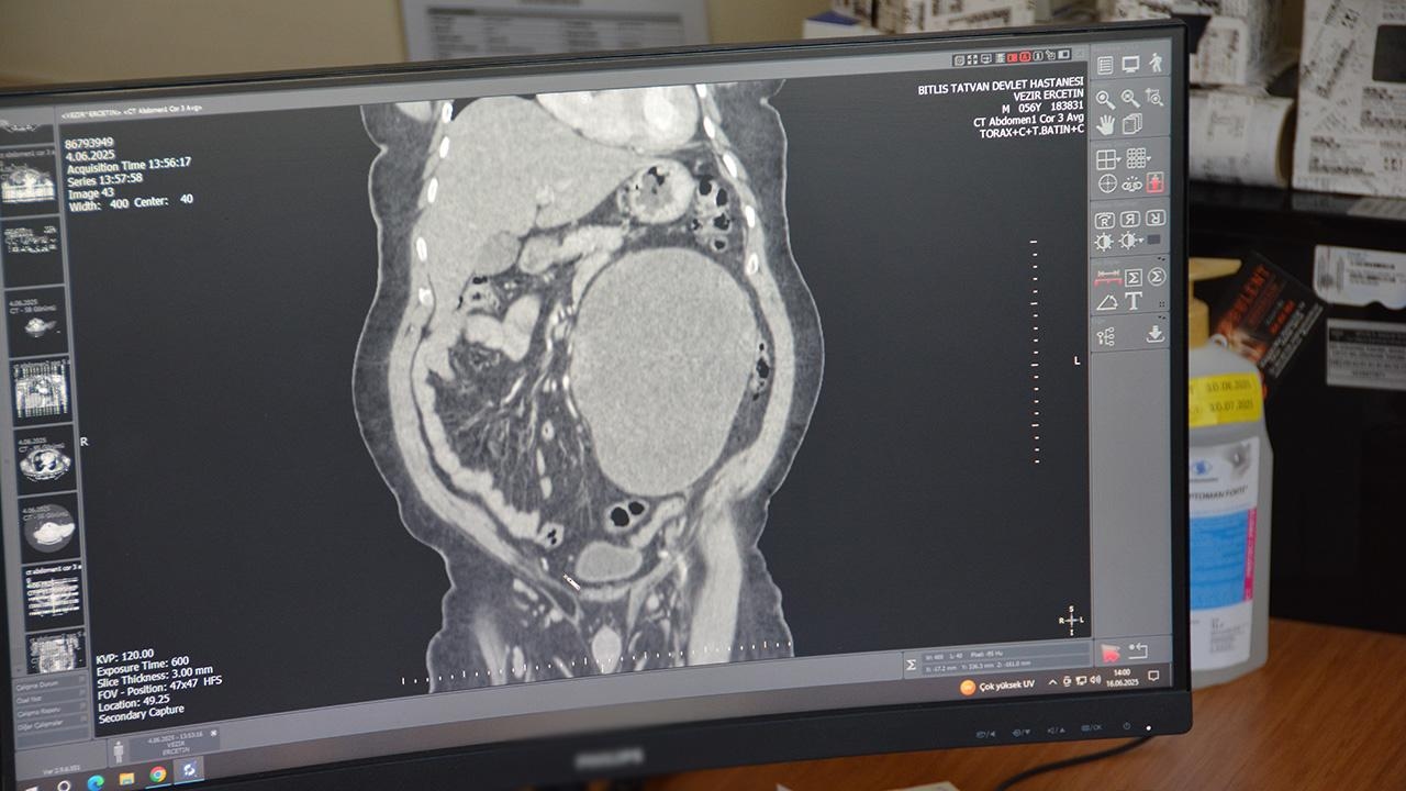 Pacjent zgłosił się do lekarza ze skargą na ból brzucha, a w jego nerce znaleziono torbiel o średnicy 23 cm.