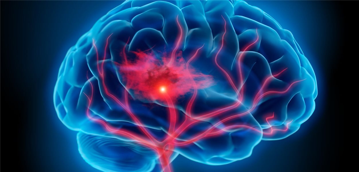 Foramen ovale, persistent: meer diagnoses bij jonge beroertepatiënten