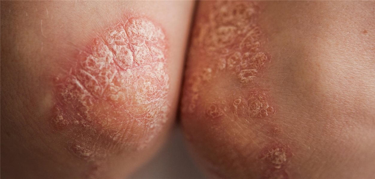 Terapia para psoríase sistêmica: fique de olho na saúde do coração!