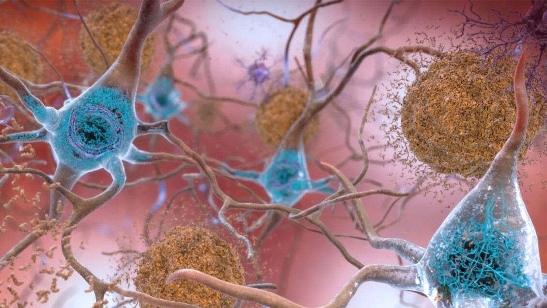 Een synthetisch eiwit tegen neurodegeneratieve ziekten