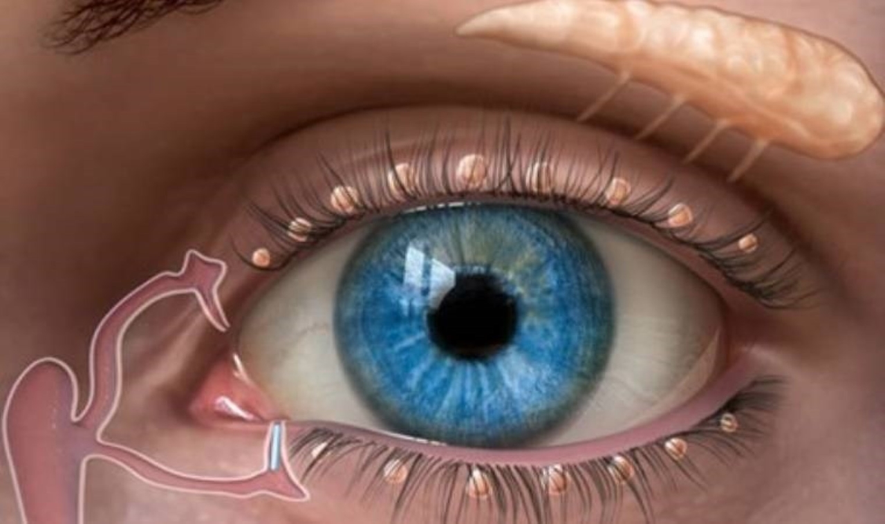 Verstopping van de traanbuis veroorzaakt infectie en heeft een negatieve invloed op het dagelijks leven: onnodige operaties maken de behandeling moeilijk