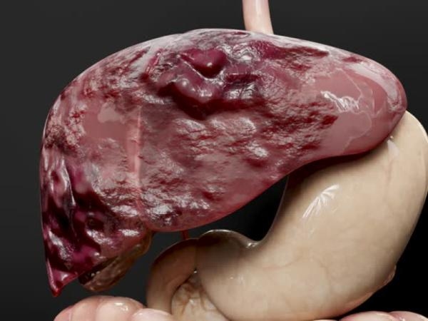 Cáncer de hígado: dos síntomas que puede identificar mientras está en el baño