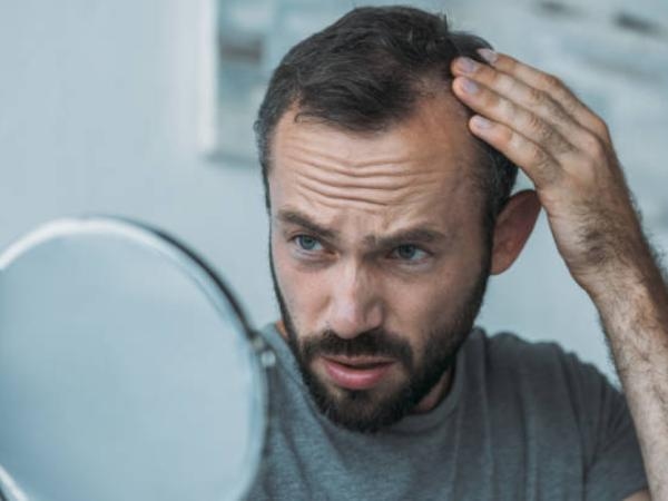 Non solo stress: 6 motivi per cui potresti diventare calvo